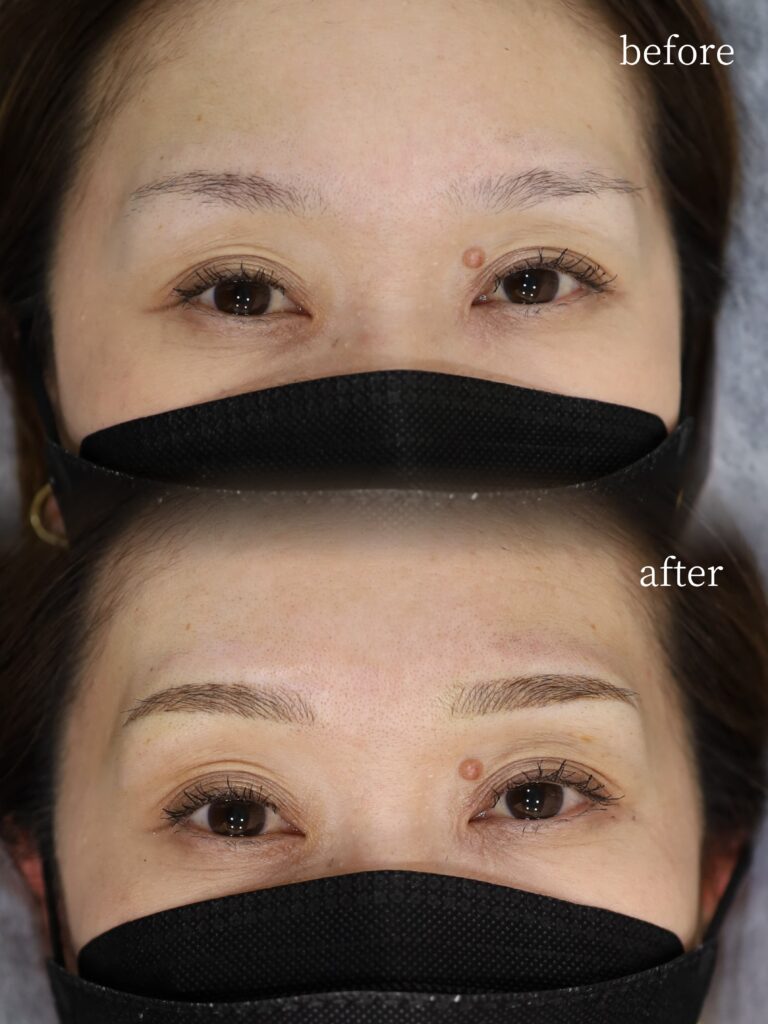 40代女性の眉アートメイク症例。眉尻の薄さを自然に補い、角度を緩やかに整えた上品で優しい印象のナチュラル眉デザイン。
